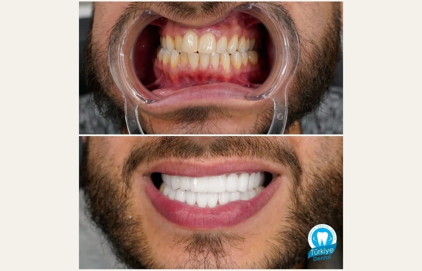 Before After 1