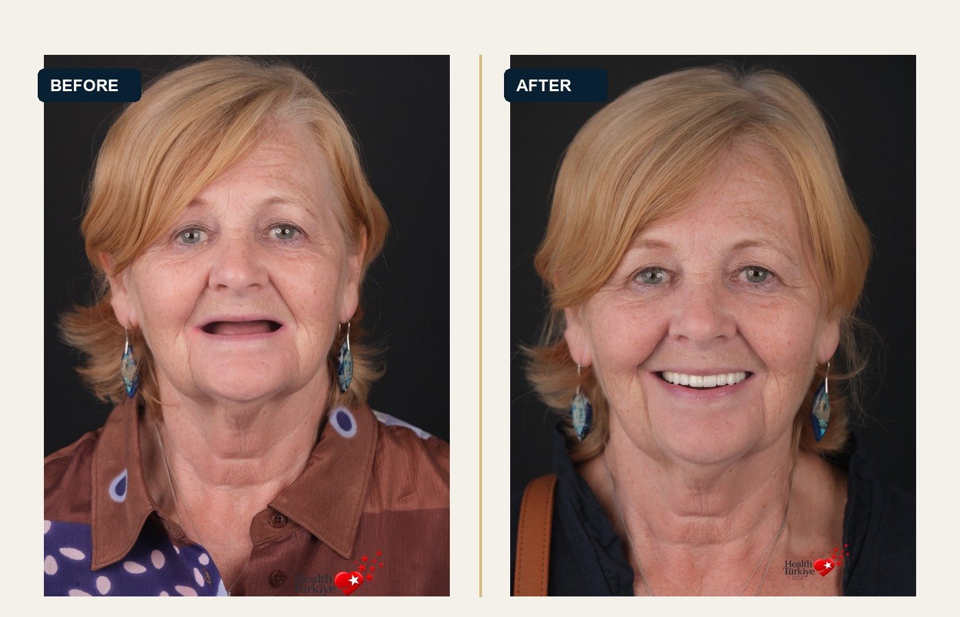 Before After 1