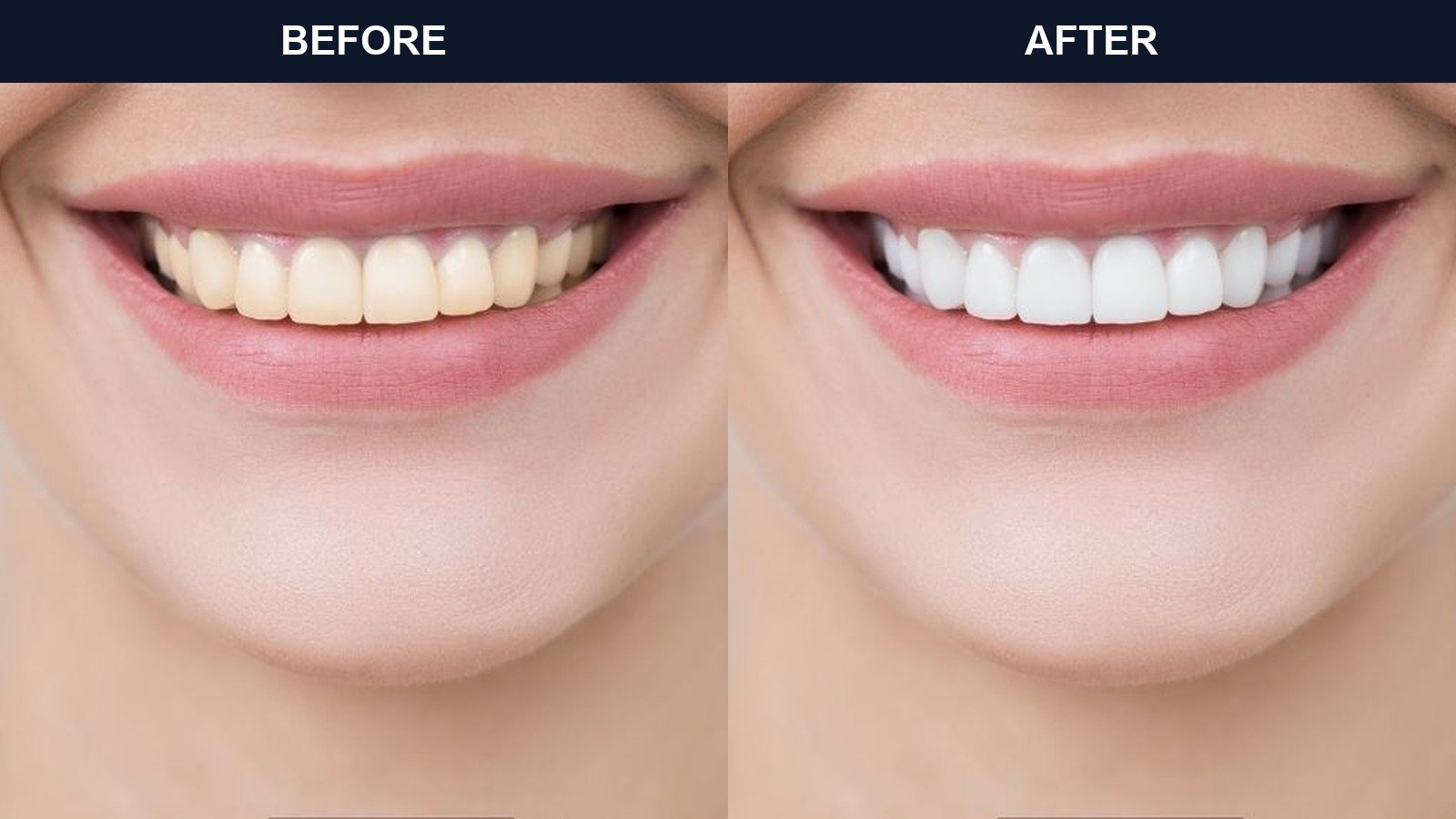 Before After 1