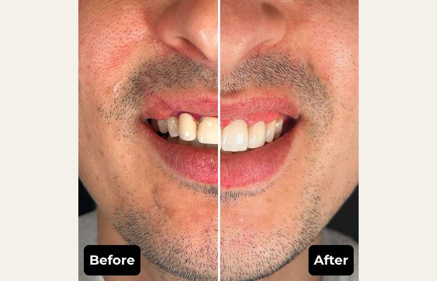 Before After 1