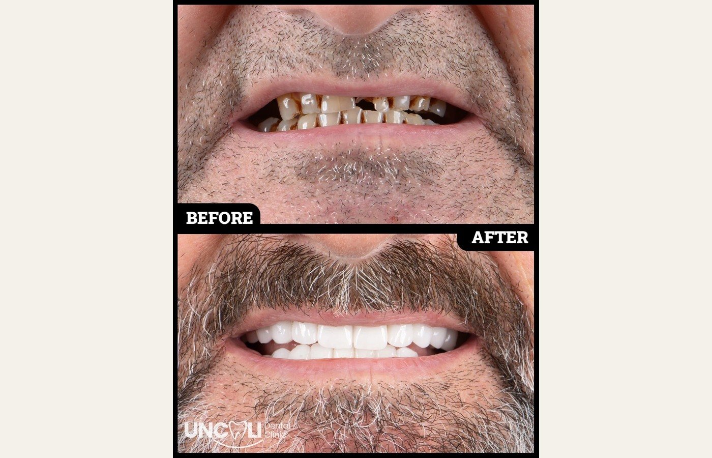 Before After 1