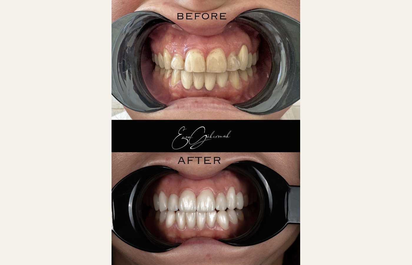 Before After 1