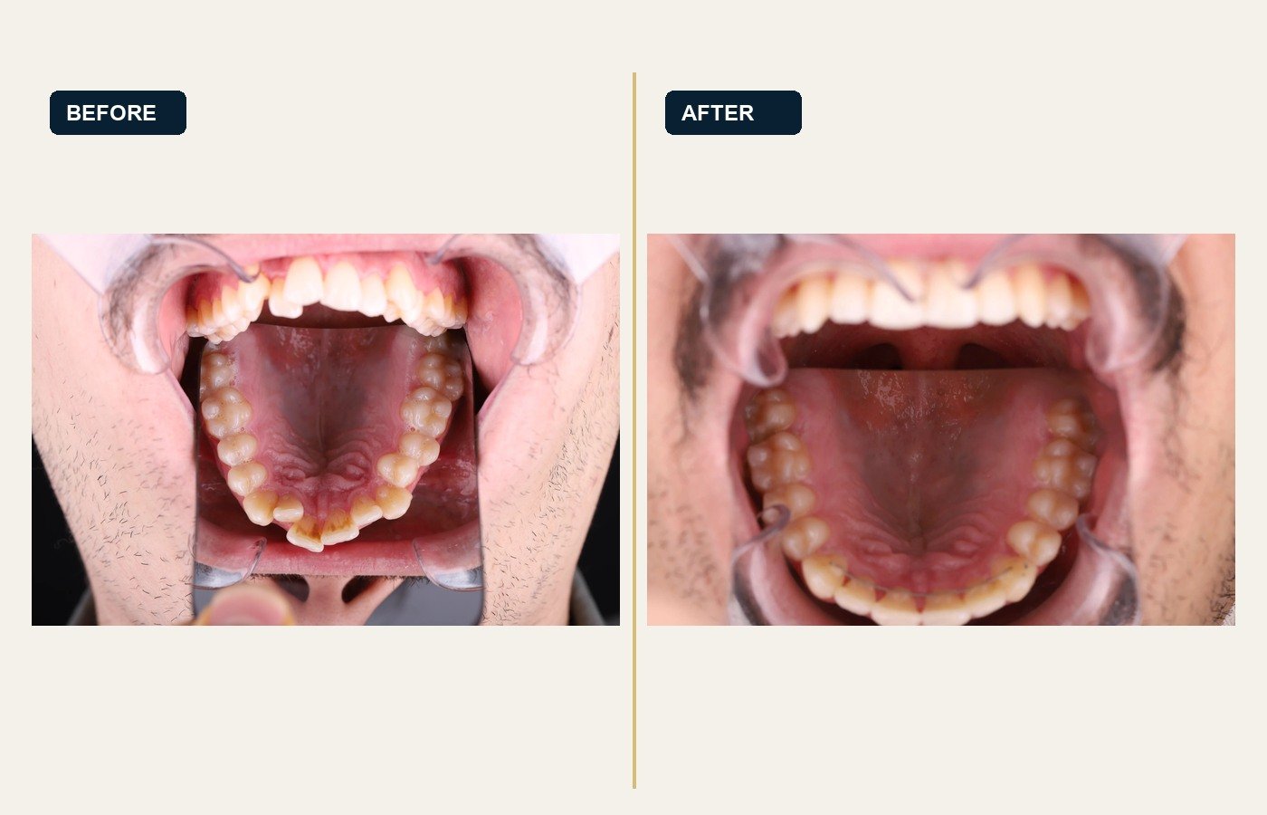 Before After 1