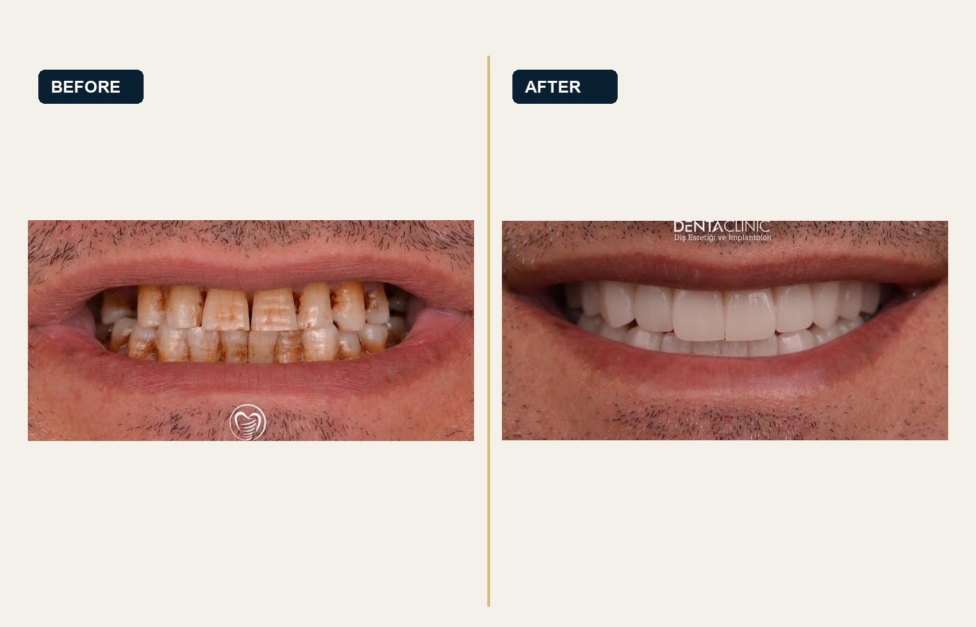 Before After 1