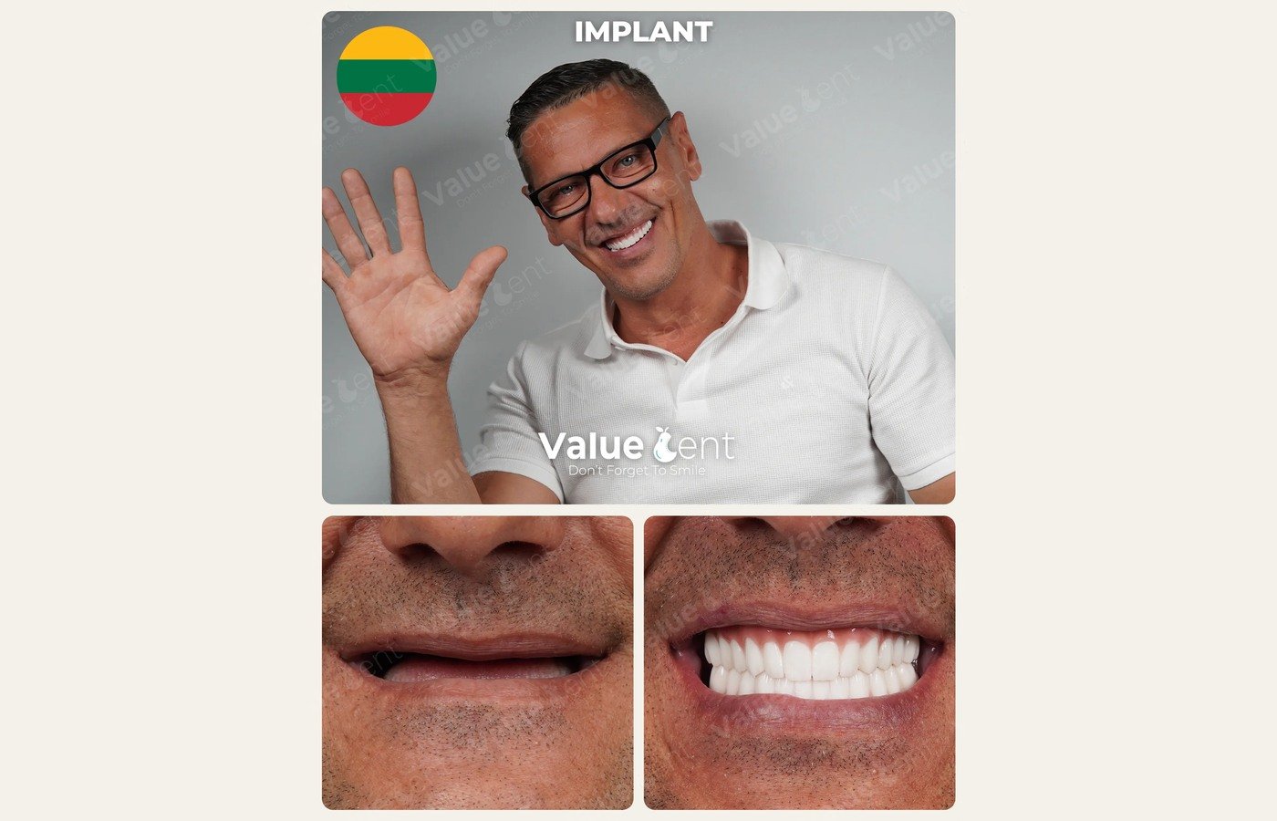 Before After 1