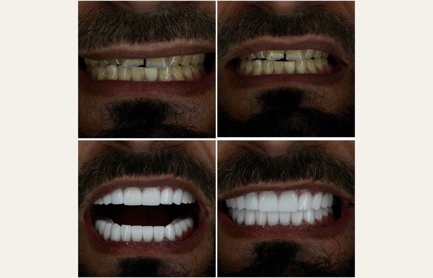 Before After 1