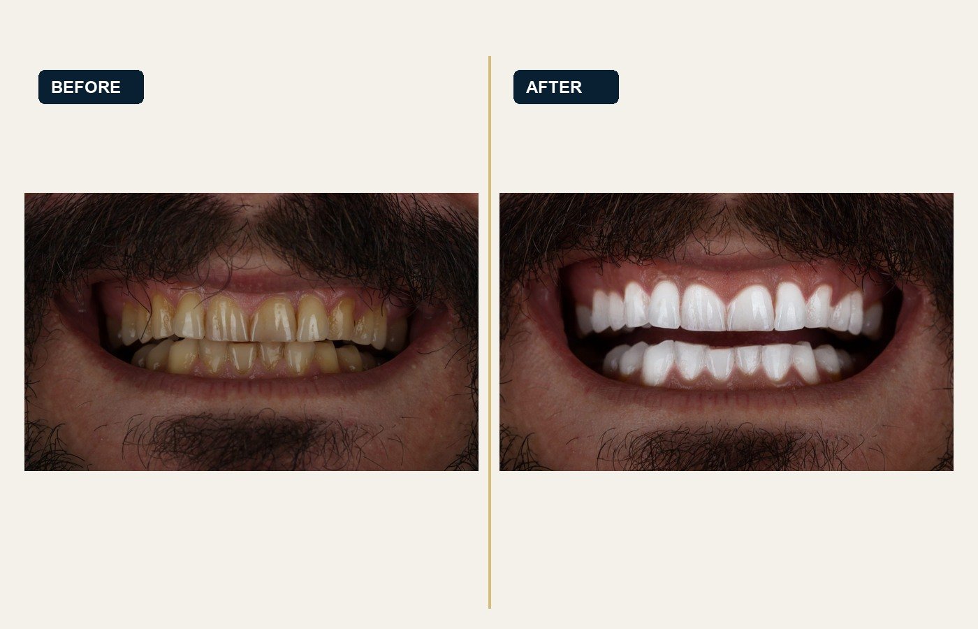 Before After 1