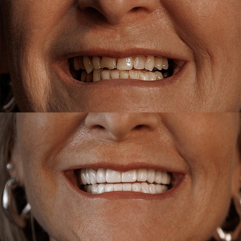 Before After 1