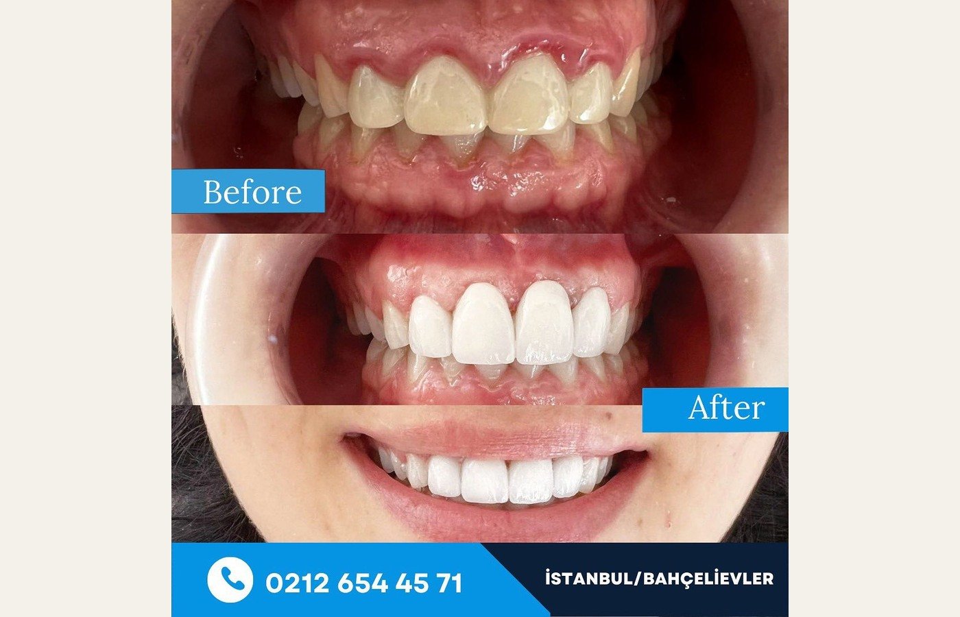 Before After 1