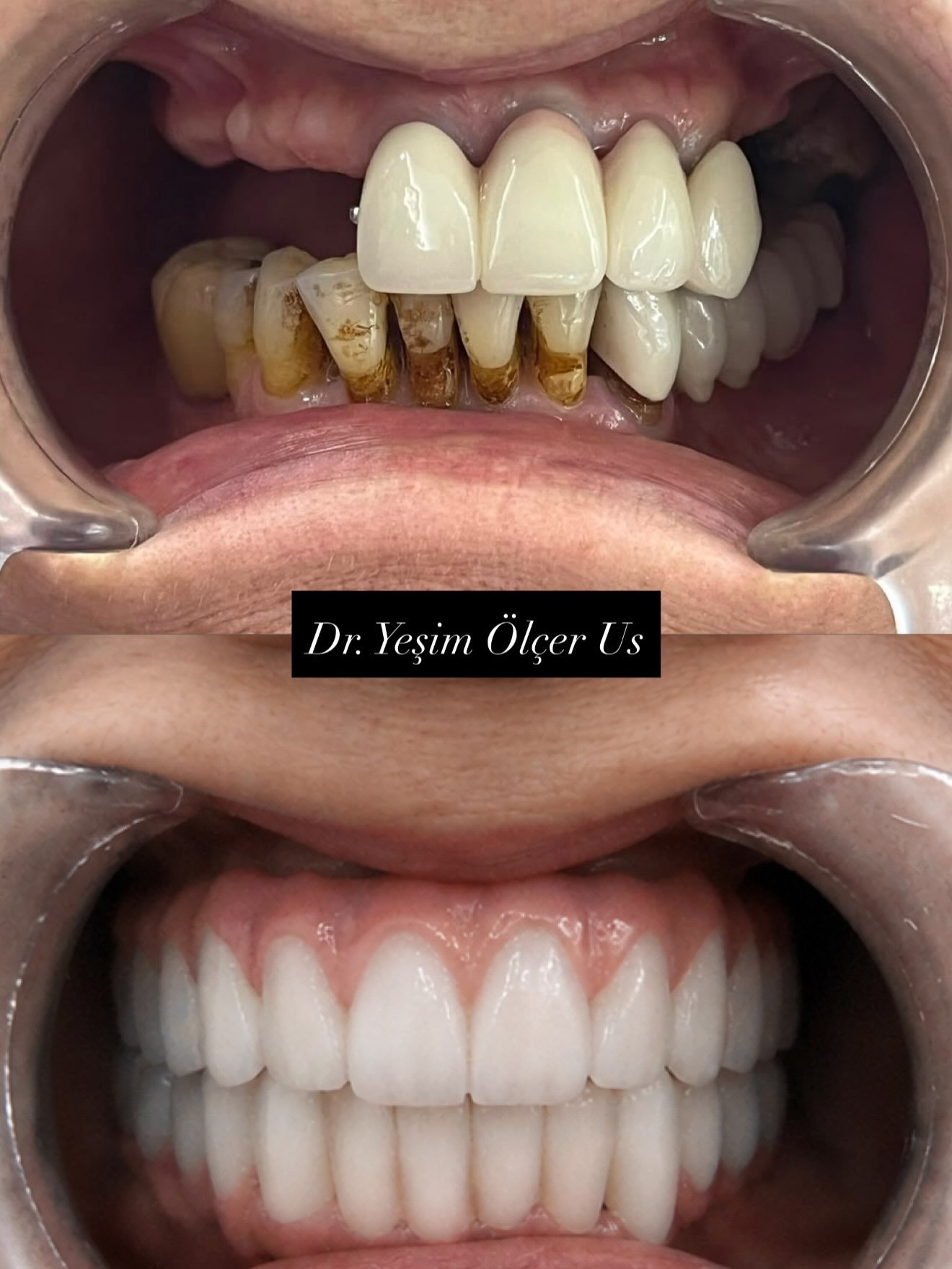Before After 1