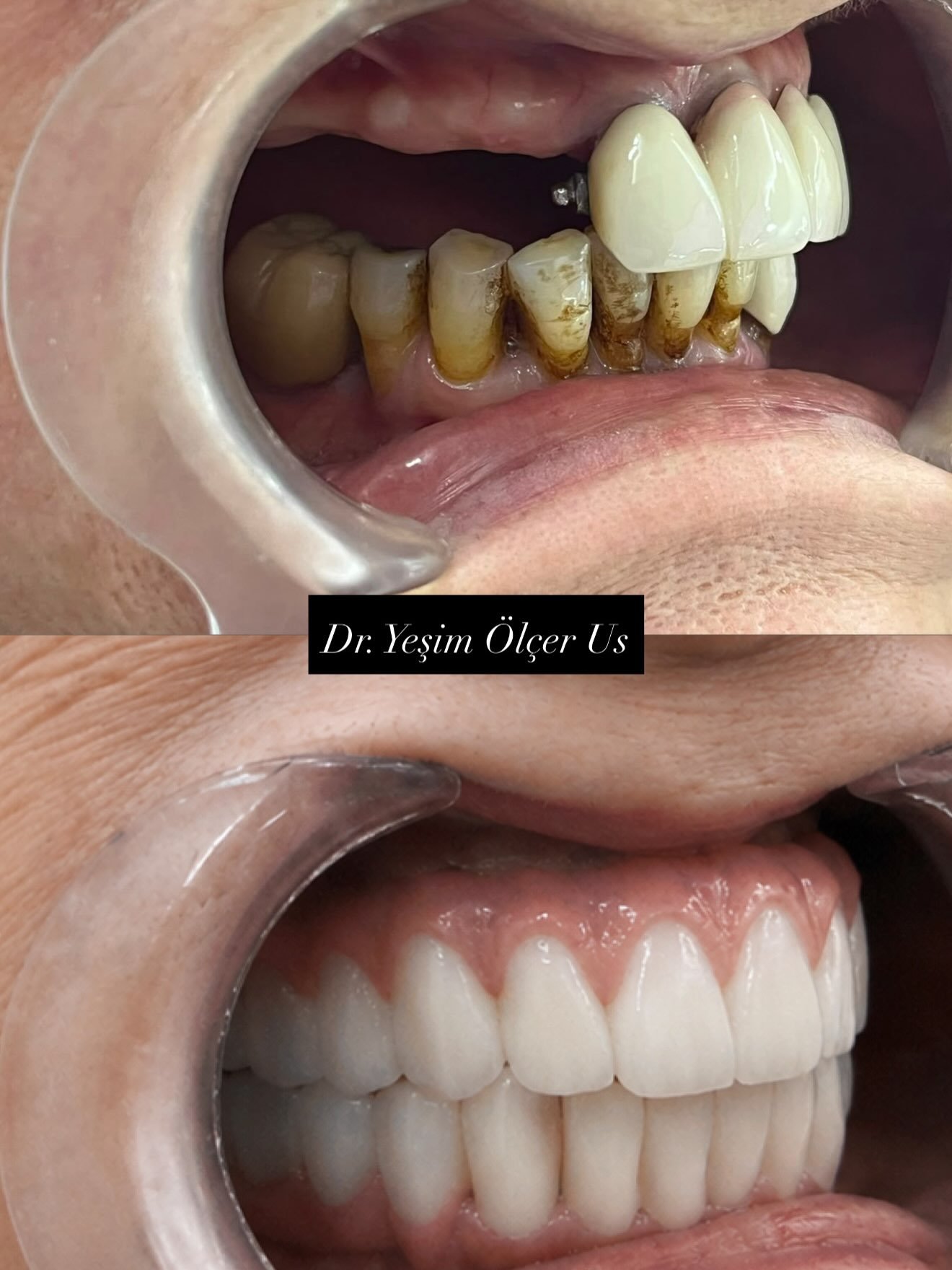 Before After 2