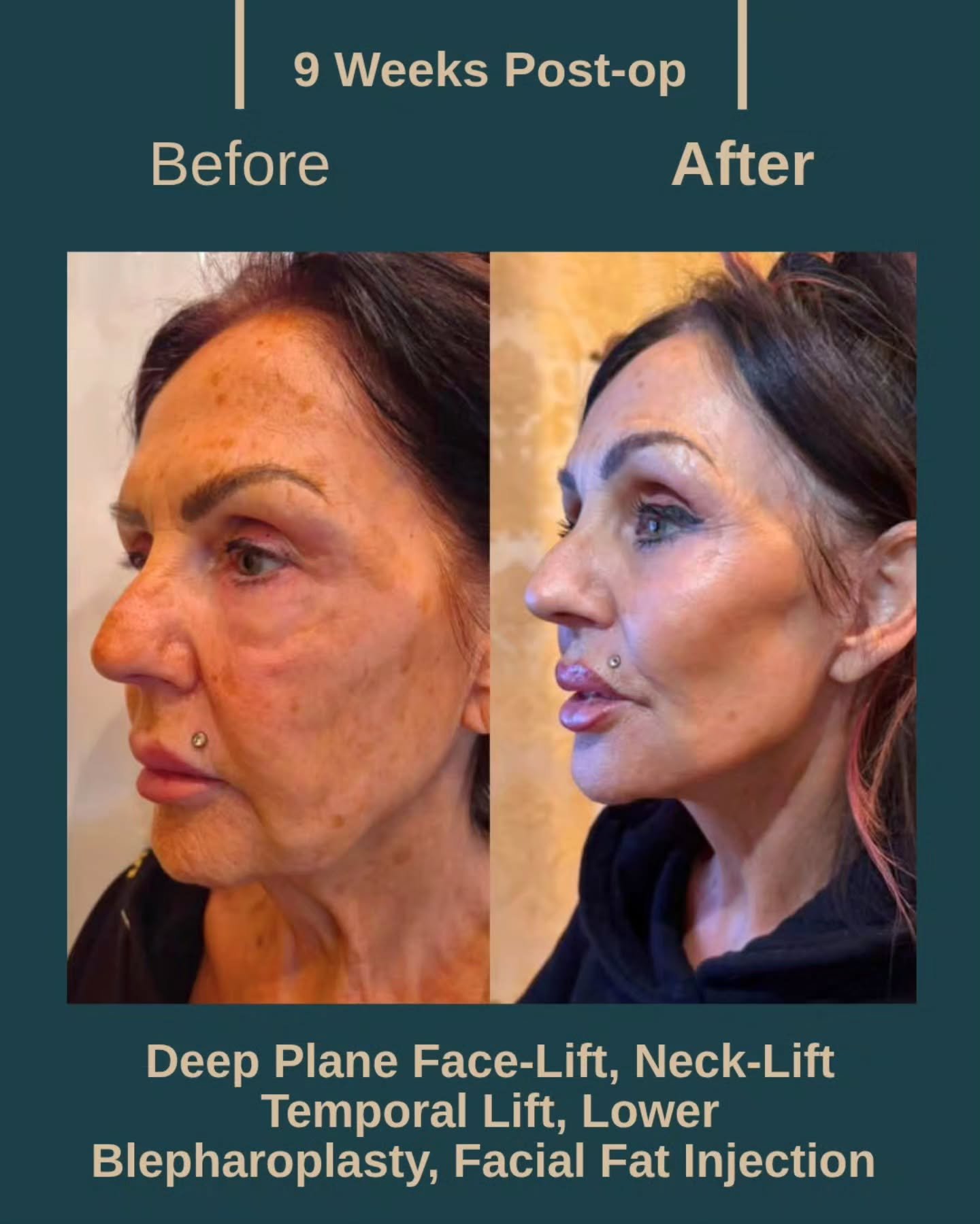 Before After 7