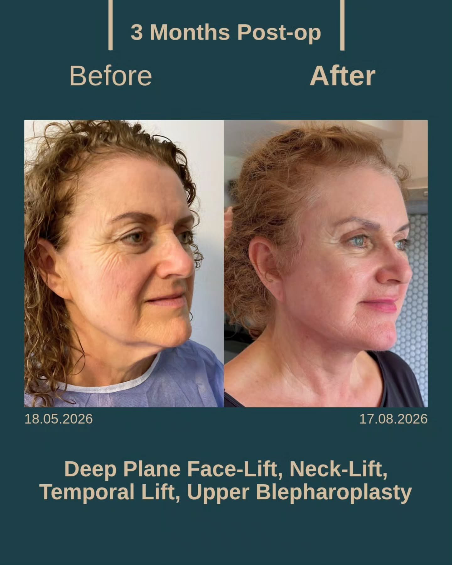 Before After 1