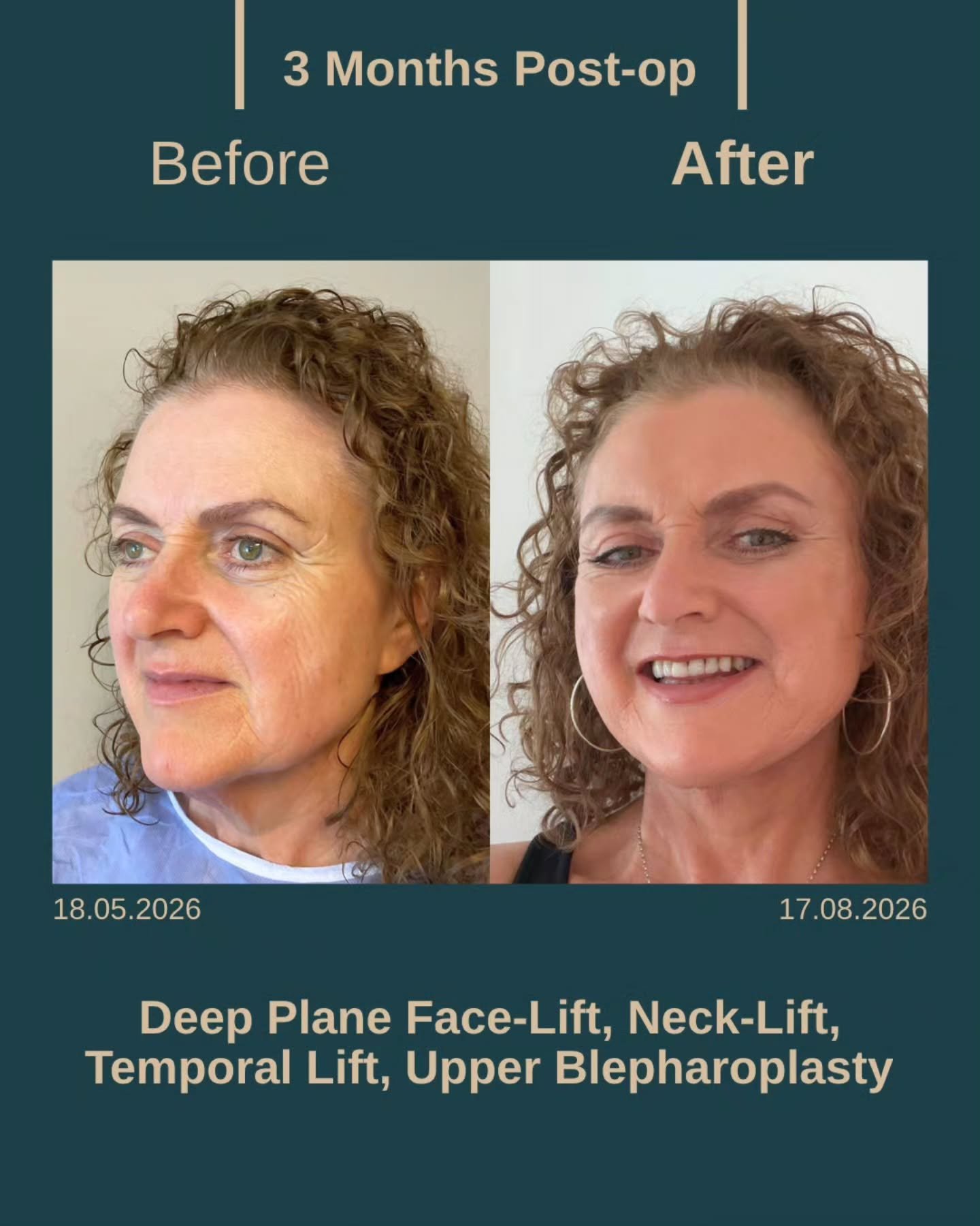 Before After 2