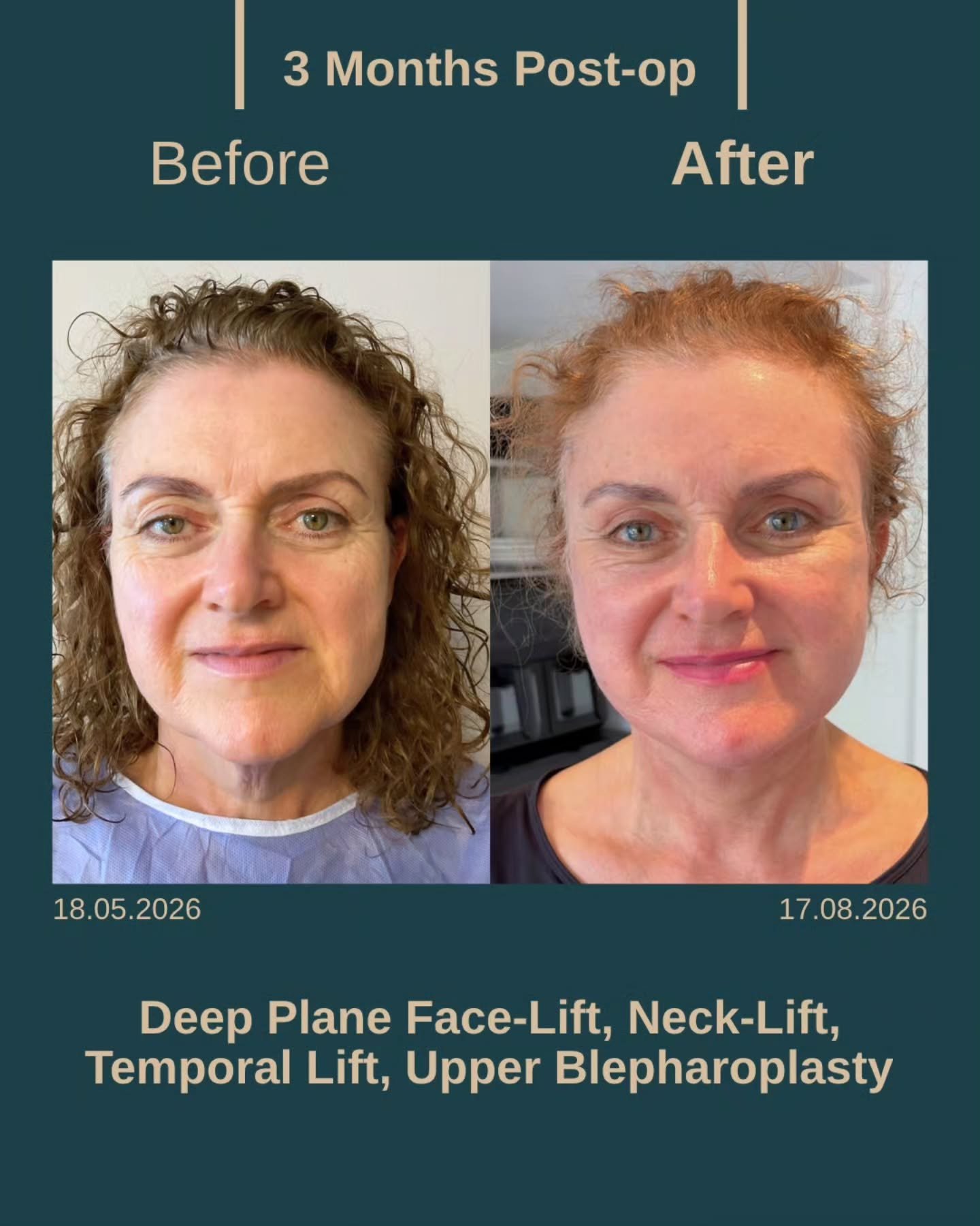 Before After 3
