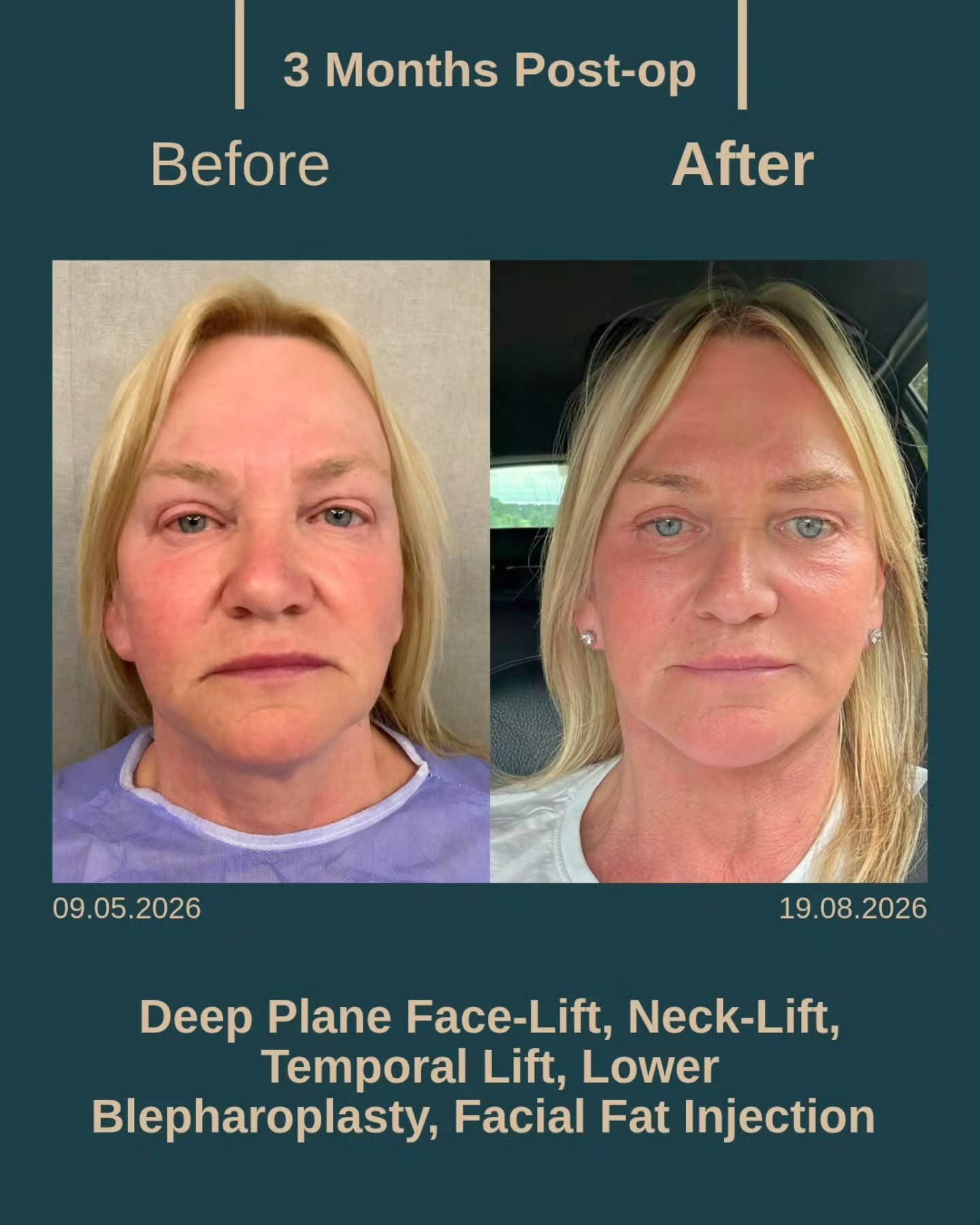 Before After 4