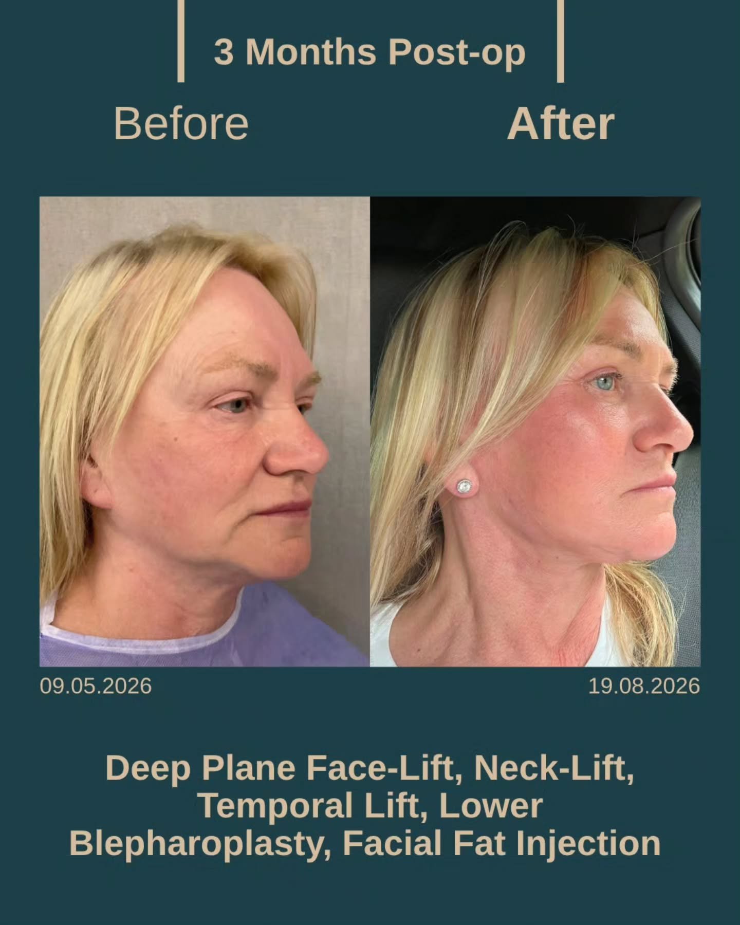 Before After 5
