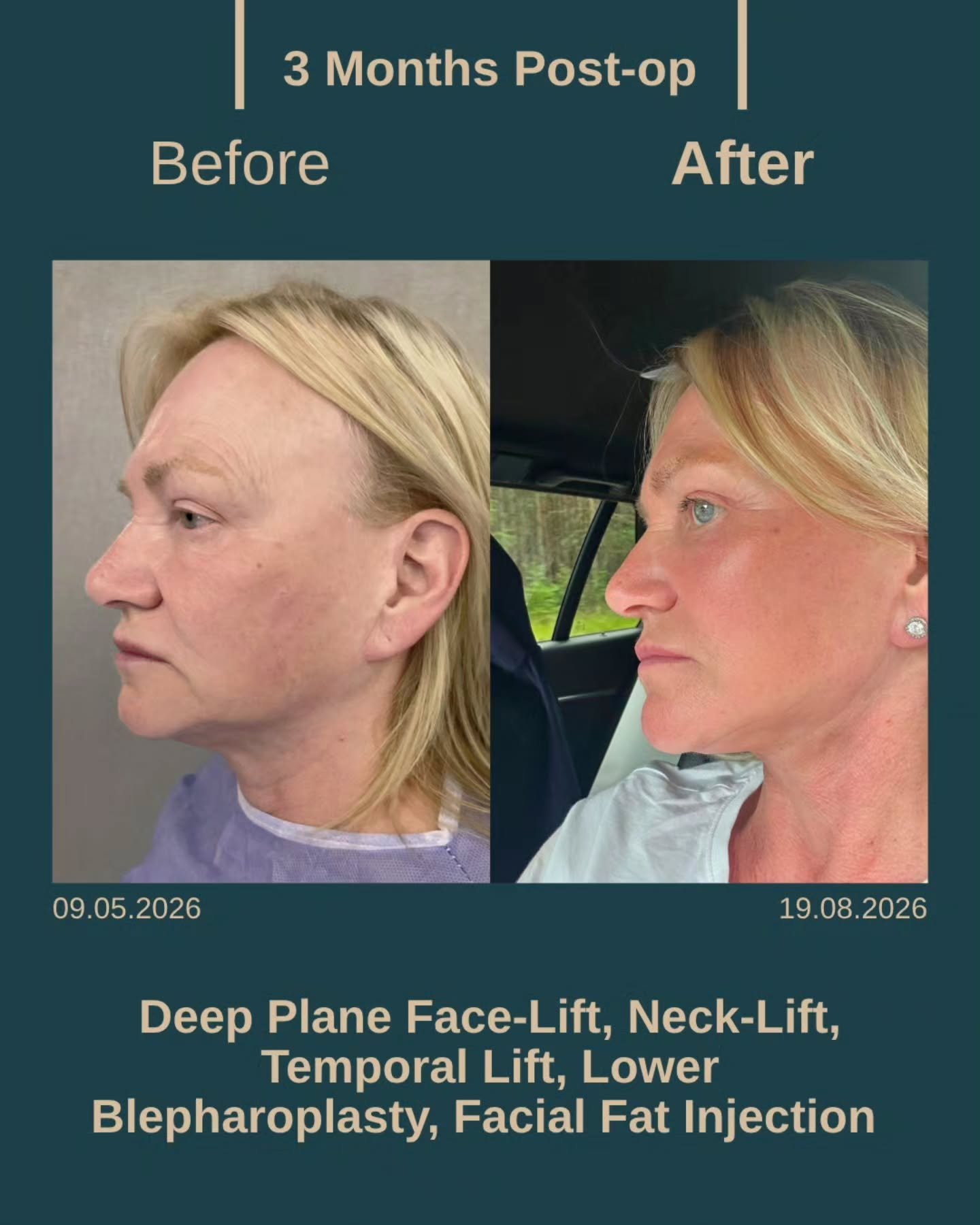 Before After 6